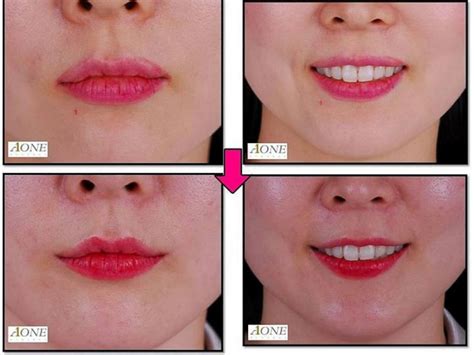 south korea lip lift surgery